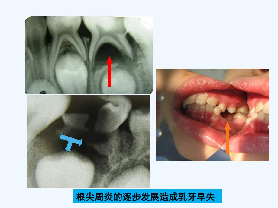 儿童牙髓病和根尖周病可修改版ppt课件_第4页