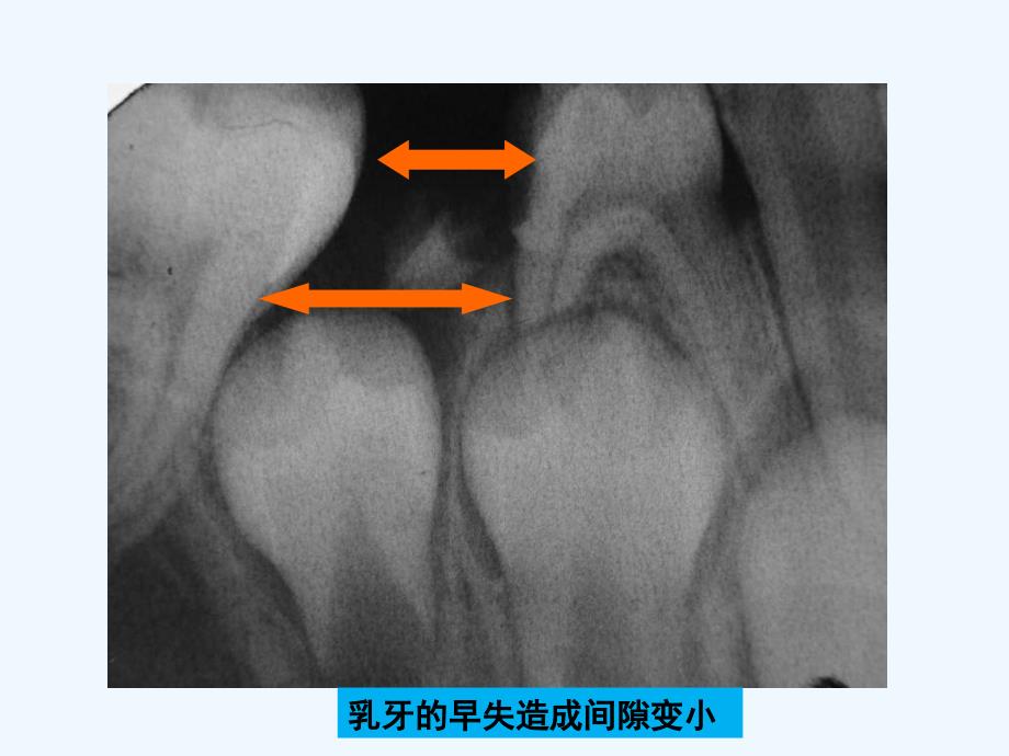 儿童牙髓病和根尖周病可修改版ppt课件_第5页