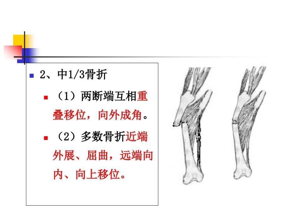 最新：股骨干折课件文档资料_第5页