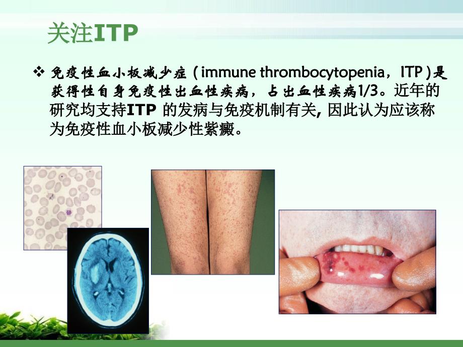 免疫性血小板减少性紫癜PPT课件_第2页