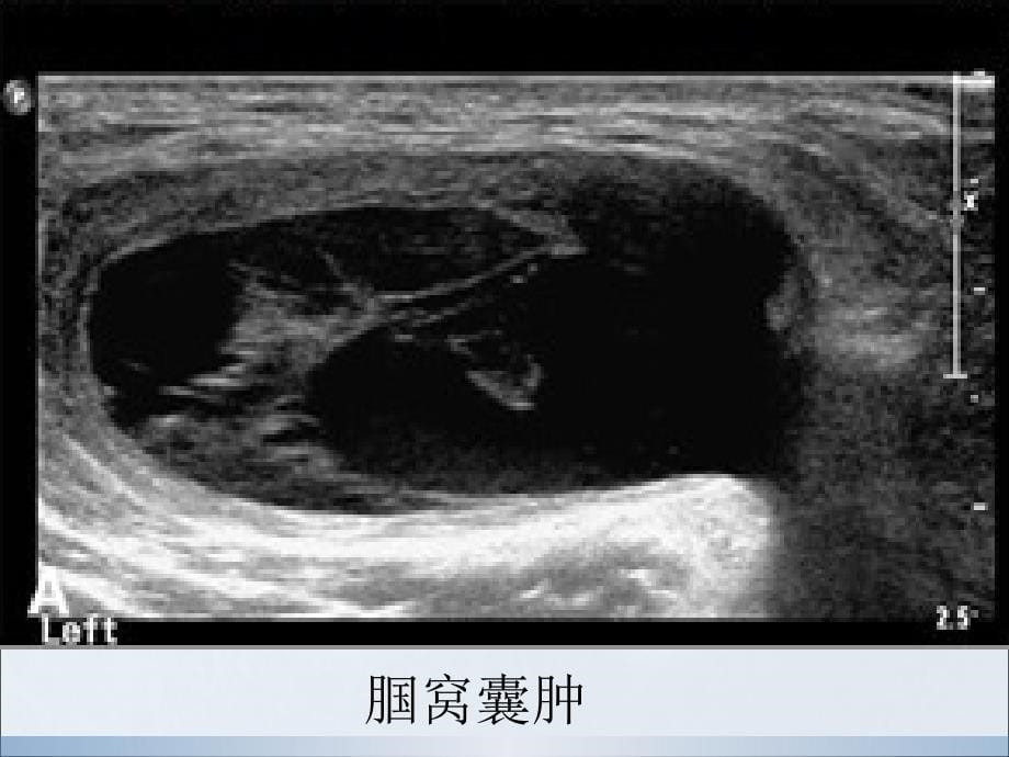 肌肉软组织肿物的超声诊断_第5页