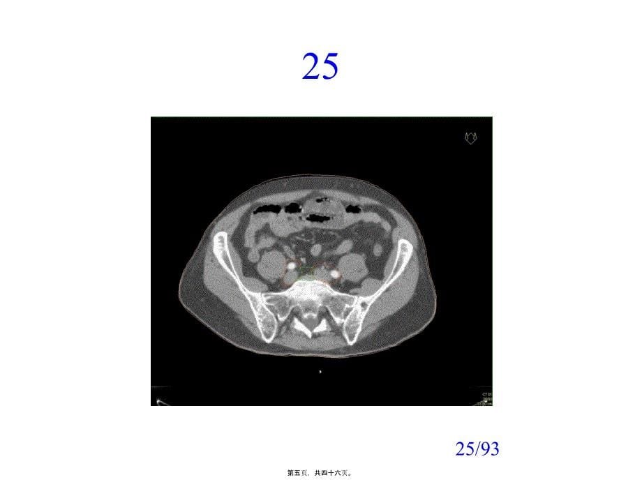 医学专题—前列腺癌淋巴结及靶区勾画20857_第5页