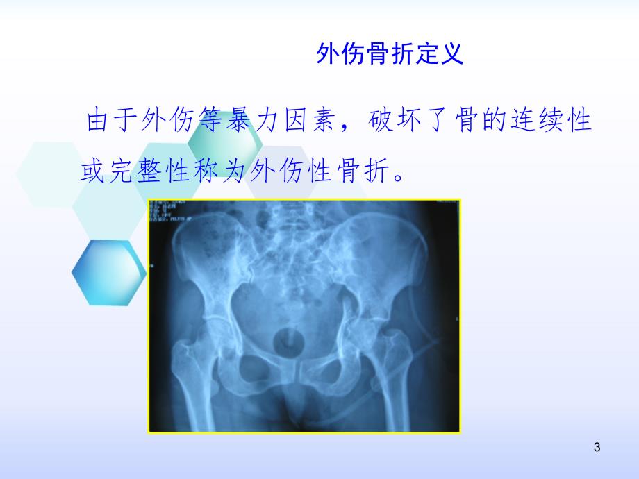 四肢骨折现场急救外固定技术PPT课件.ppt_第3页