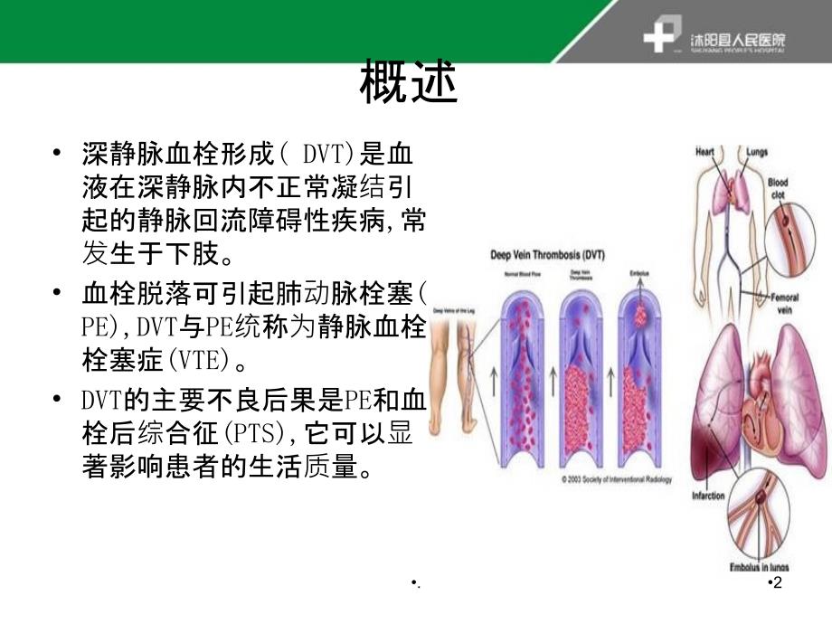 深静脉血栓指南PPT课件_第2页