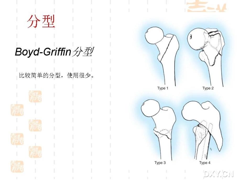 股骨粗隆间骨折内固定治疗选择及策略ppt课件_第4页