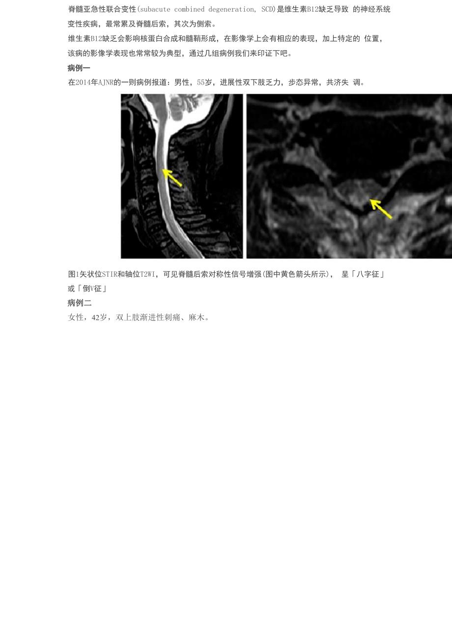 脊髓亚急性联合变性的典型表现_第2页