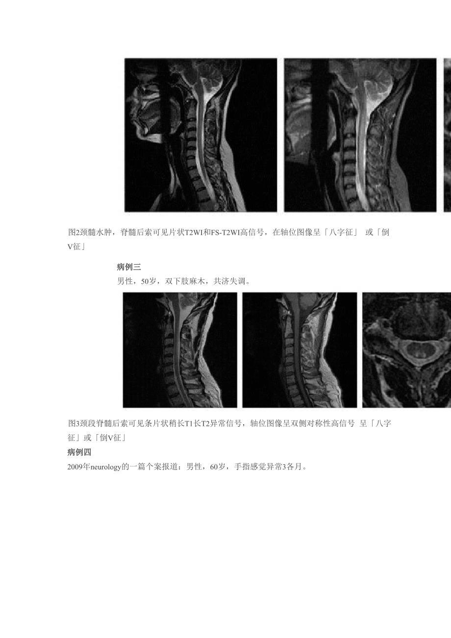 脊髓亚急性联合变性的典型表现_第3页