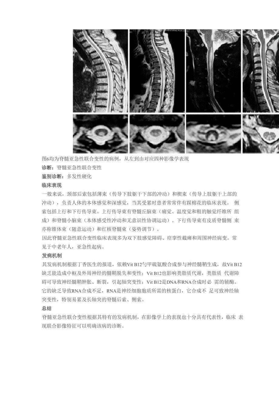 脊髓亚急性联合变性的典型表现_第5页