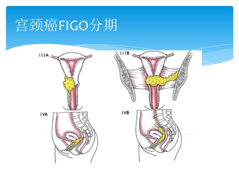 腹腔镜广泛子宫切除术_第4页