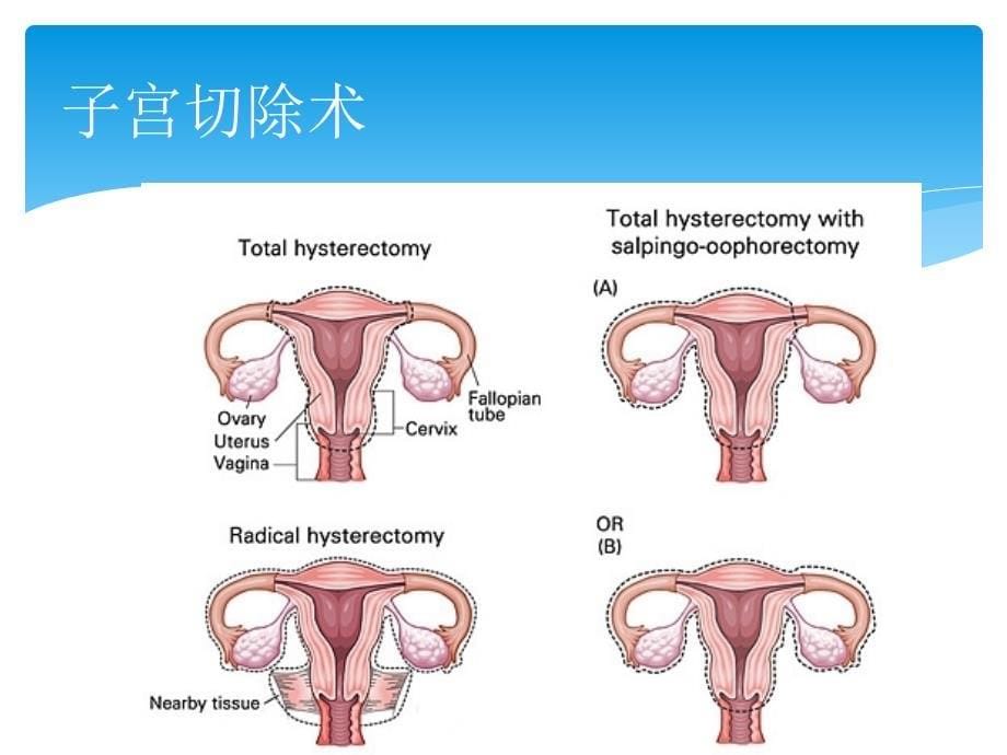 腹腔镜广泛子宫切除术_第5页