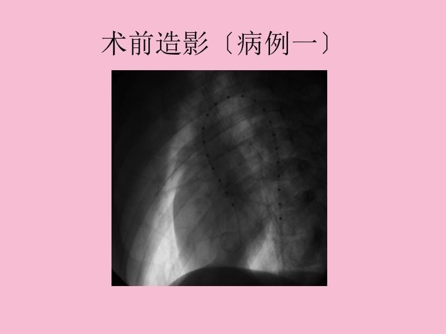 室缺右室面多破口的介入封堵ppt课件_第5页