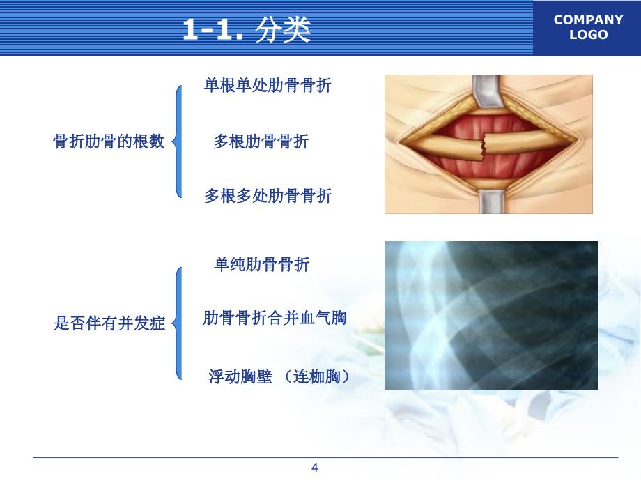 肋骨骨折的外科治疗_第4页