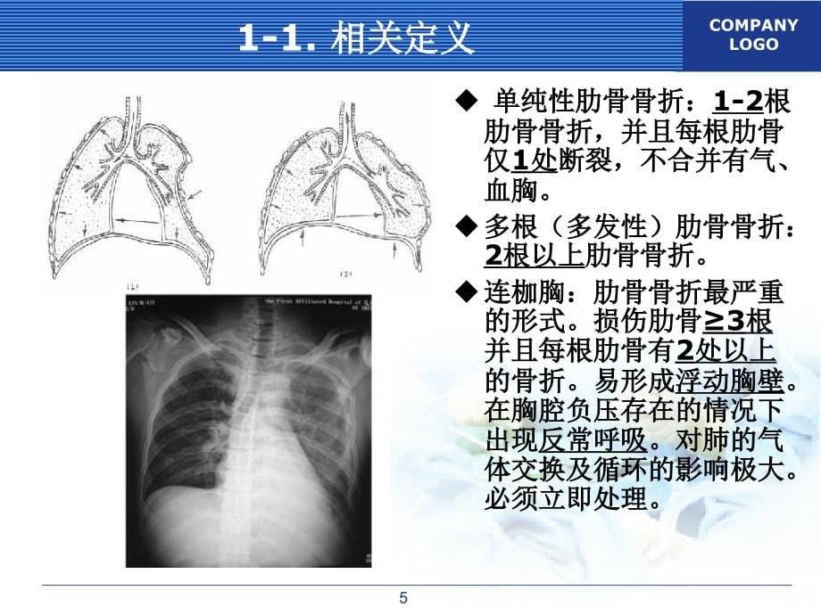 肋骨骨折的外科治疗_第5页