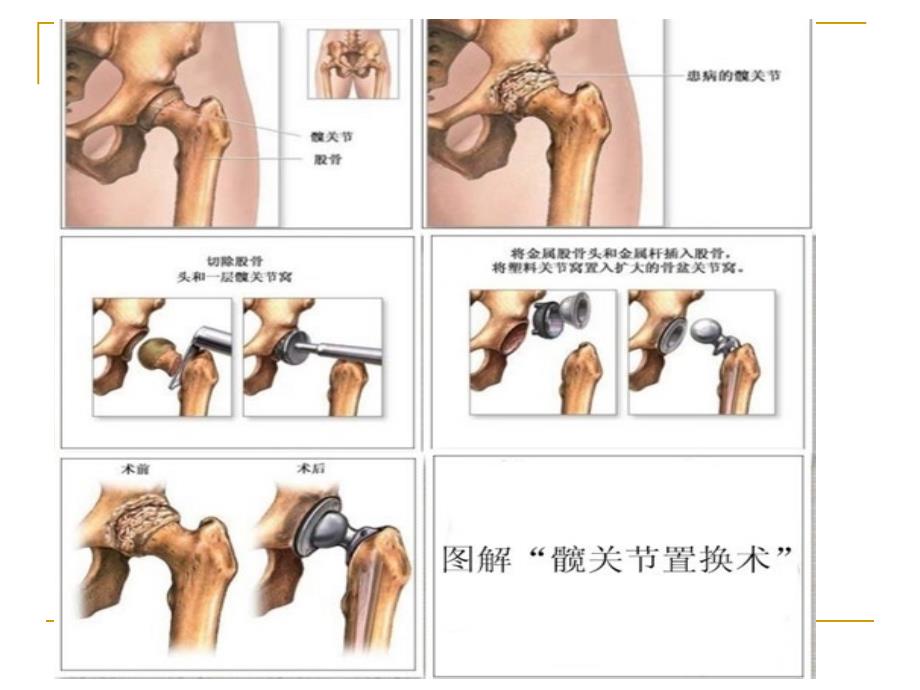 髋关节置换术后的康复训练_第4页