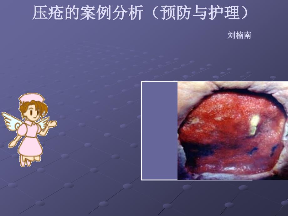 褥疮课件.ppt_第1页