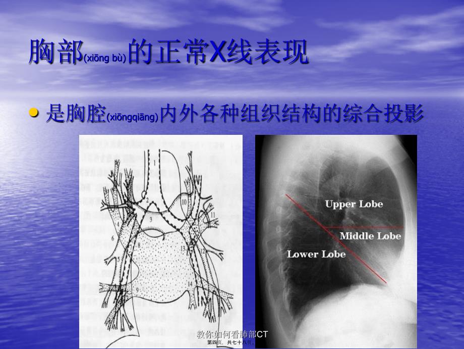 教你如何看肺部CT课件_第4页