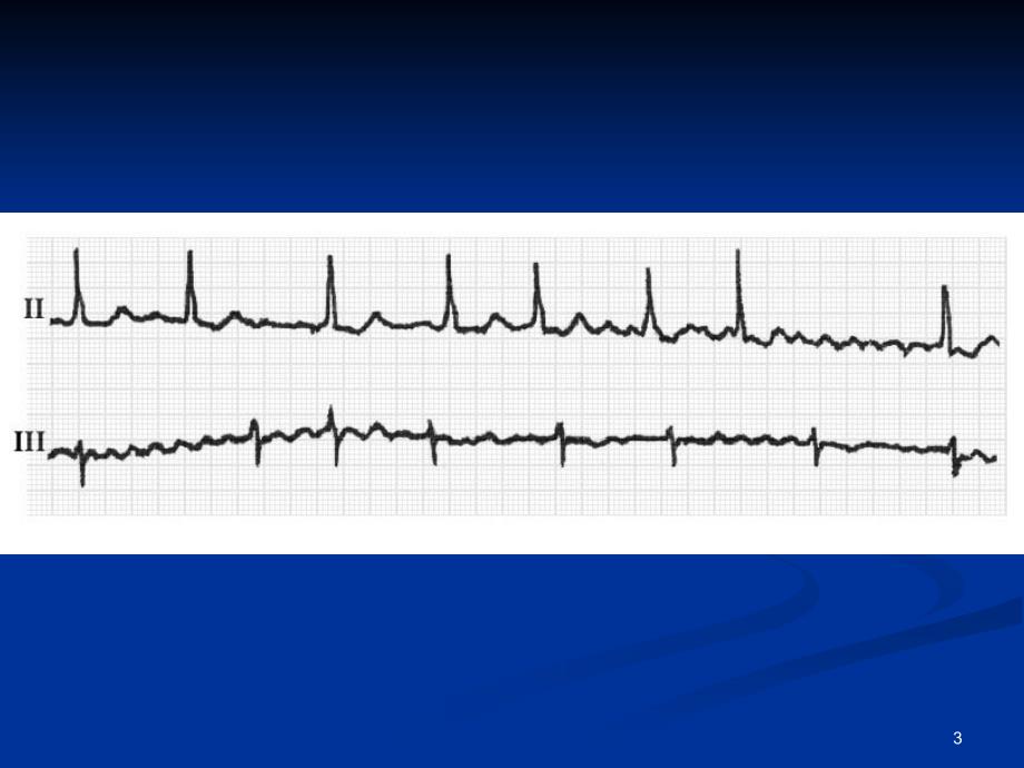 房颤的心电图诊断_第3页