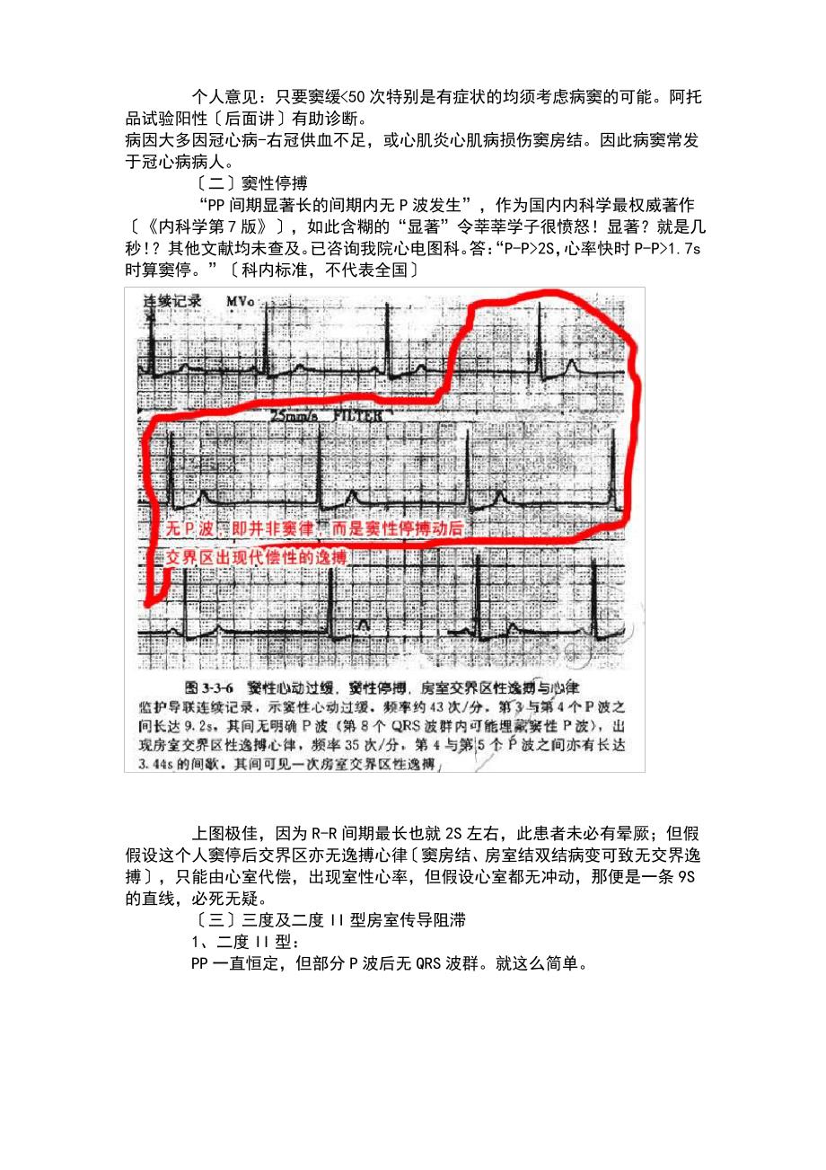 怎么看心电图_第4页