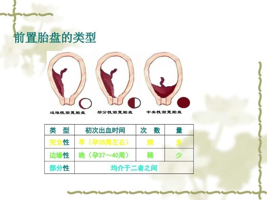 前置胎盘的护理查房_第5页