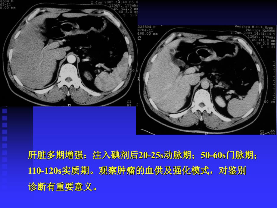 医学影像学：第六章第二部分 肝胆胰_第4页