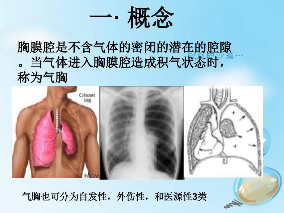 小莫自发性气胸课件_第3页