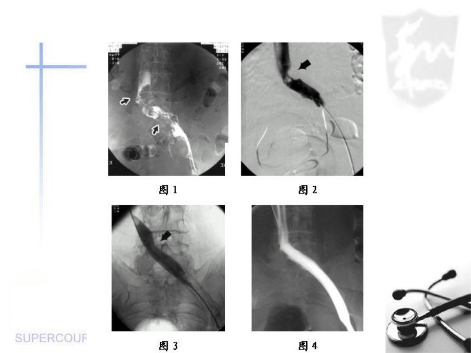 介入溶栓治疗DVT课件_第4页