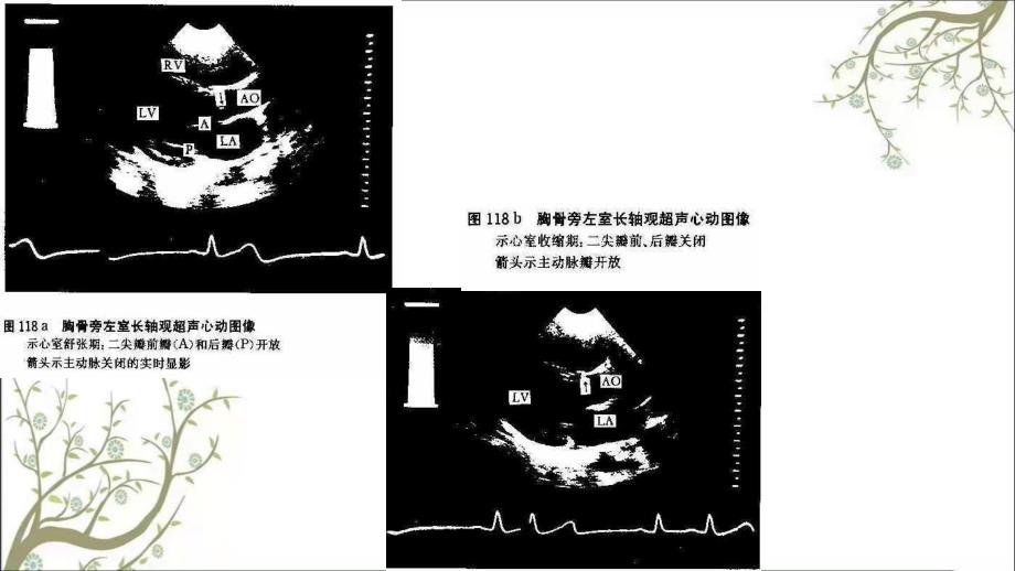 心脏超声与心脏断面解剖及室壁心段_第3页