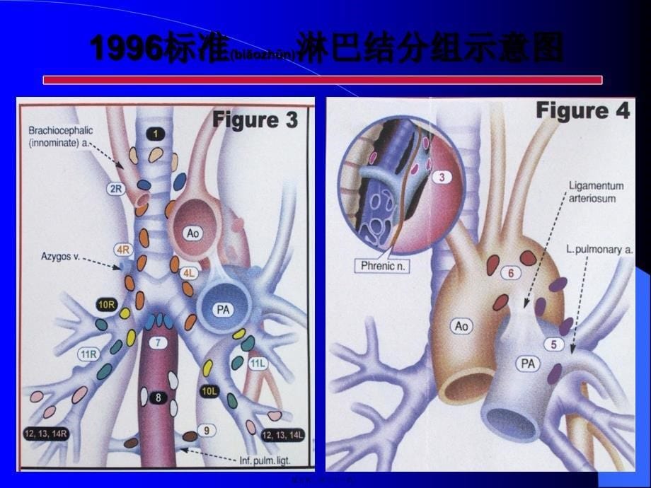 医学专题—胸部淋巴结的国际标准分区30579_第5页