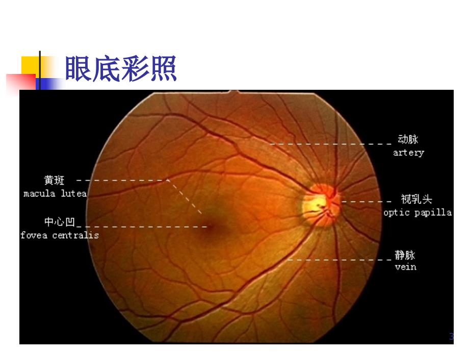 视网膜中央静脉阻塞的诊断及治疗PPT参考幻灯片_第3页