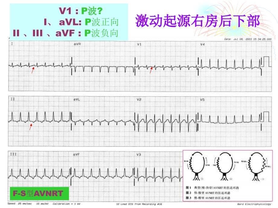 窄QRS心动过速心电图诊断及鉴别诊断_第5页