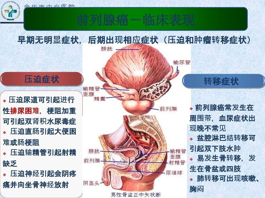 前列腺癌的粒子治疗_第5页