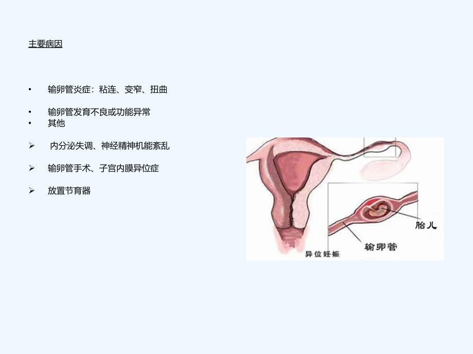 宫外孕腹腔镜术前术后护理_第3页