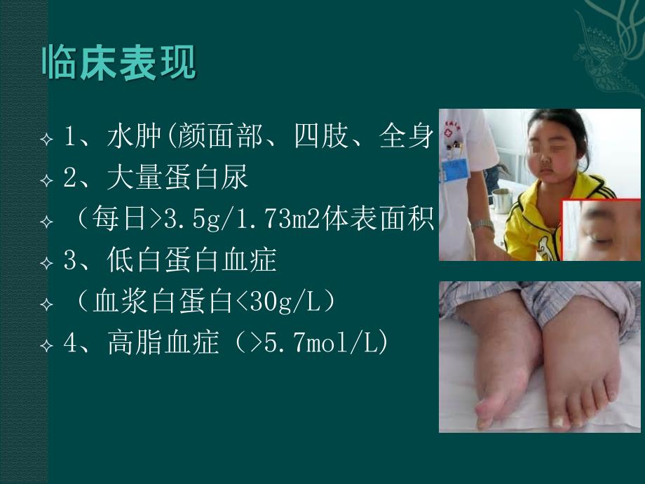 肾病综合征的护理10722.ppt_第4页