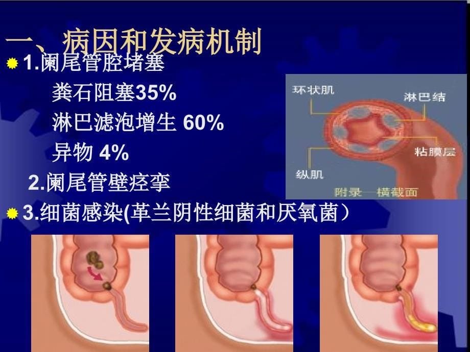 临床医学概要34阑尾炎溃疡穿ppt课件_第5页