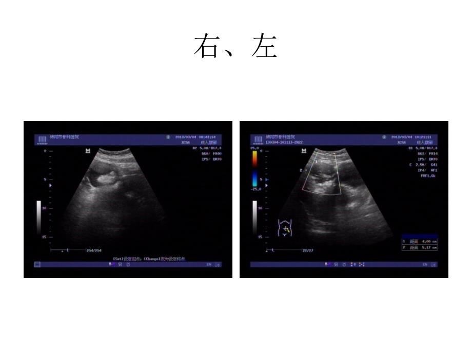 畸胎瘤的超声诊断课件_第3页