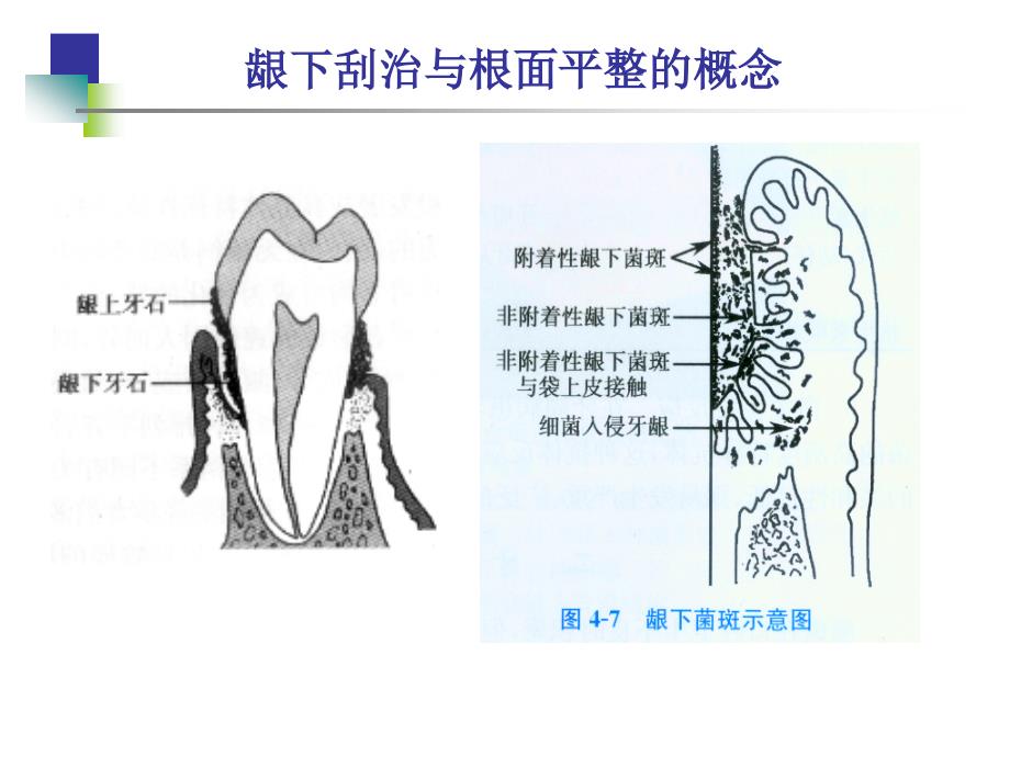 龈下刮治与根面平整_第4页