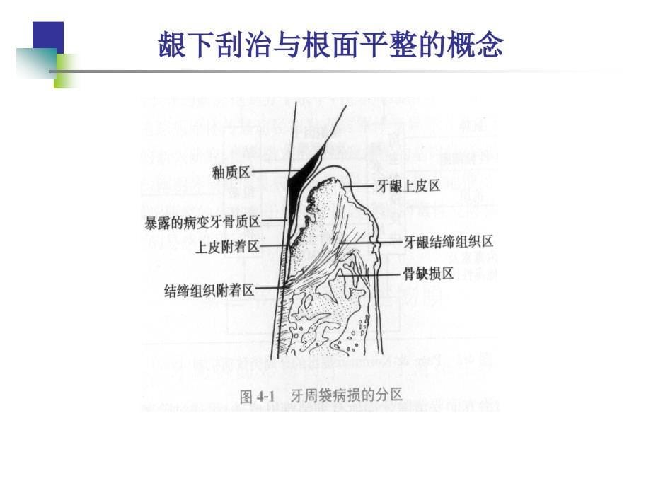 龈下刮治与根面平整_第5页