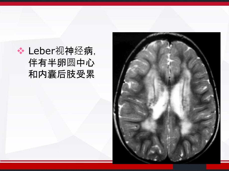 多发性硬化的鉴别诊断课件_第4页