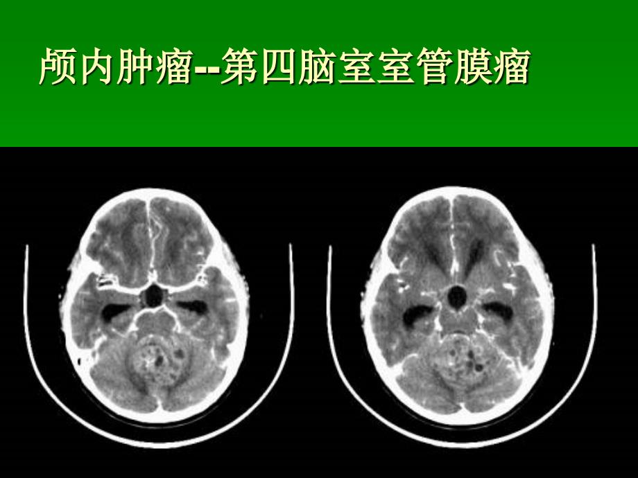 颅内肿瘤 PPT课件.ppt_第3页