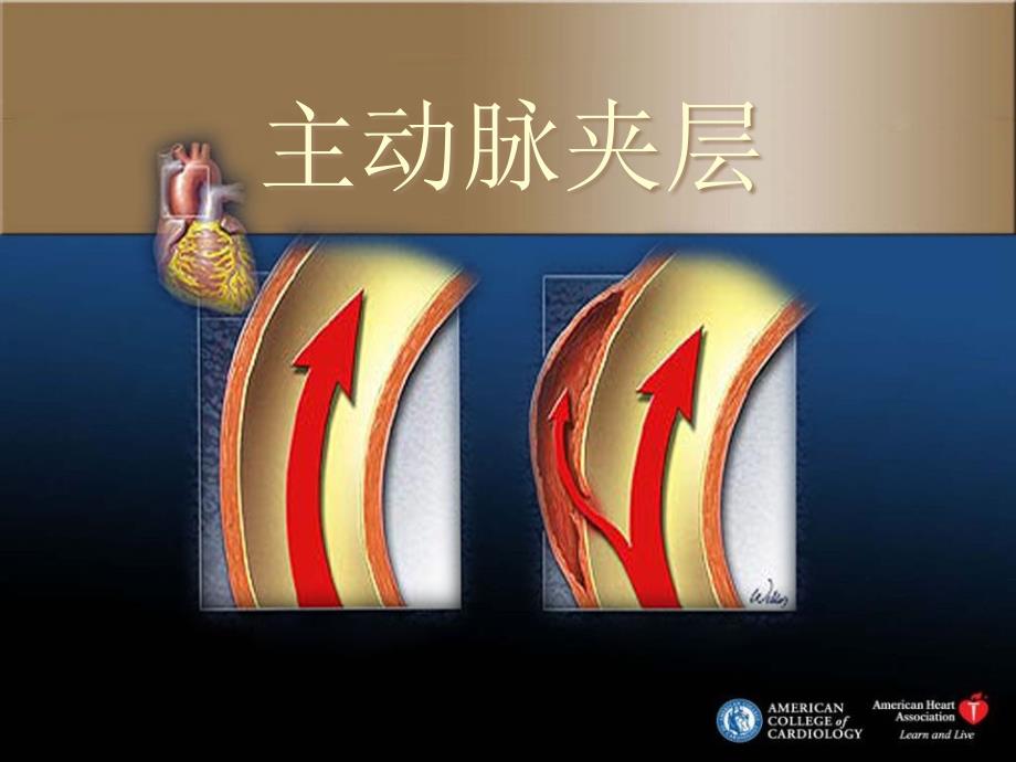 教学-主动脉夹层课件_第1页