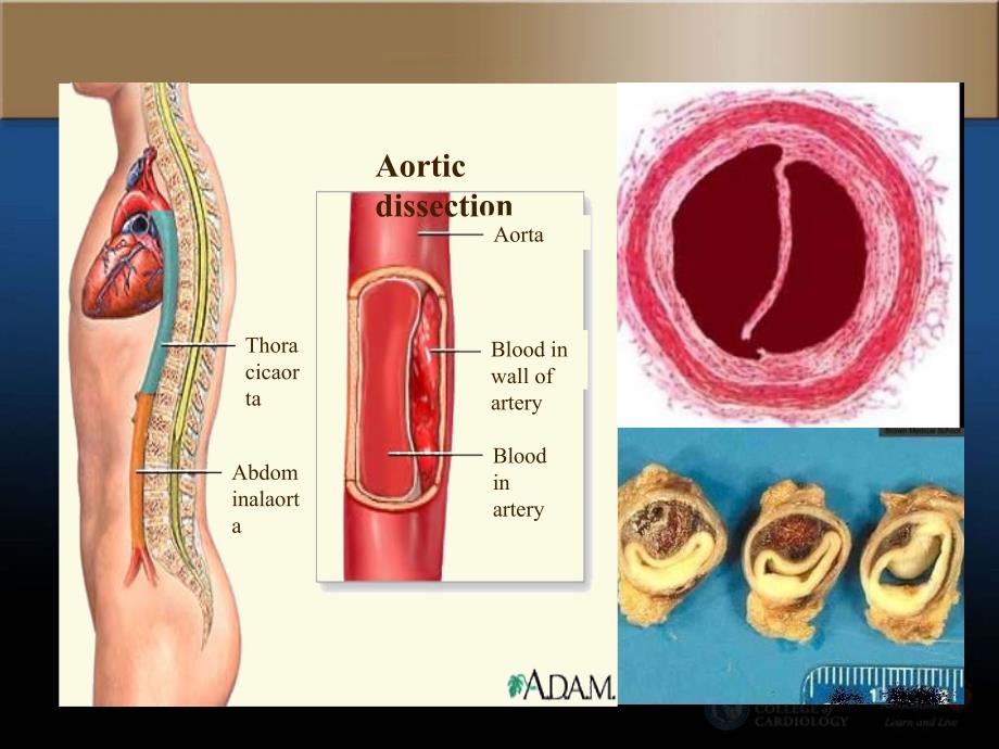 教学-主动脉夹层课件_第3页