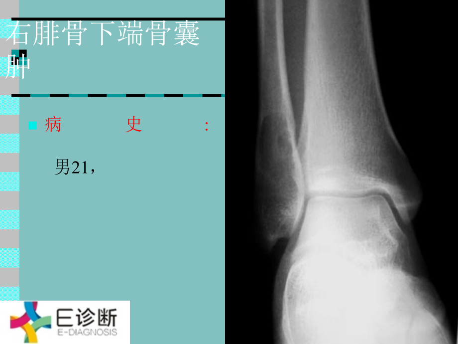 医学影像-骨肿瘤X线病例图谱_第1页