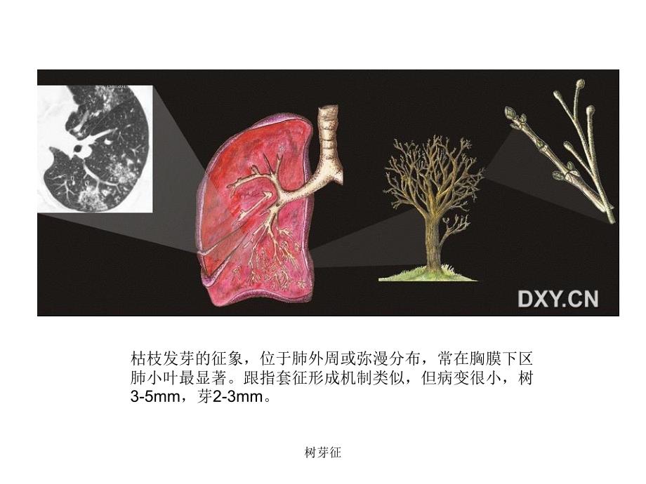 树芽征概述-《树芽征》优秀课件_第4页