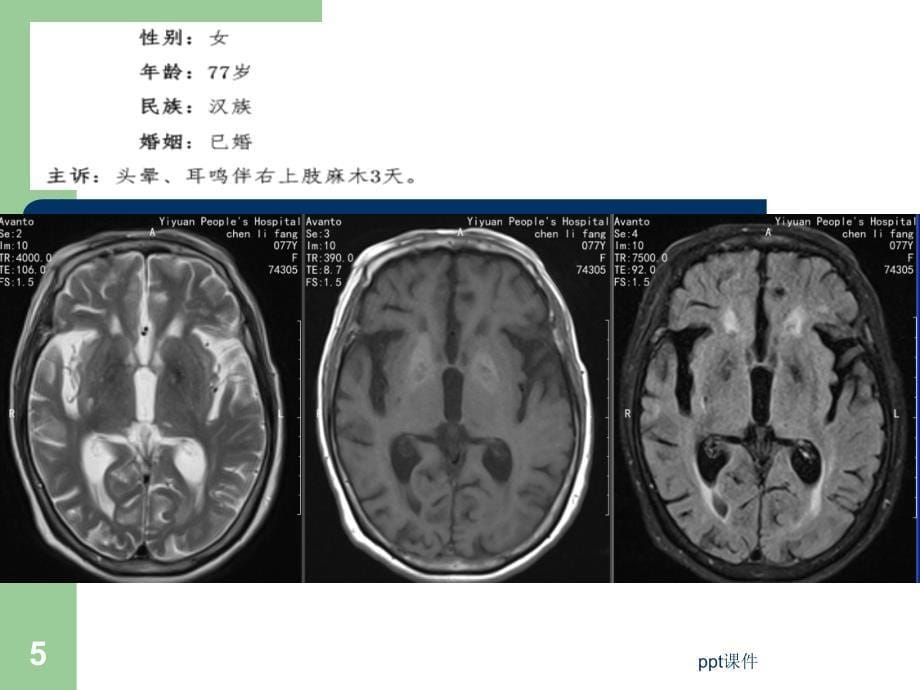 基底节区T1WI高信号病例--课件_第5页