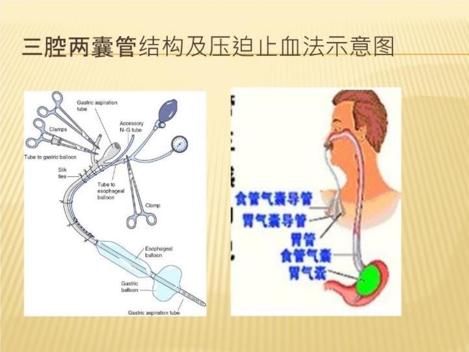 三腔两囊管及五腔三囊管压迫止血法教学文案_第4页