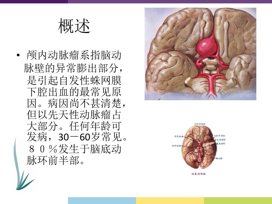 颅内动脉瘤ppt课件_第2页