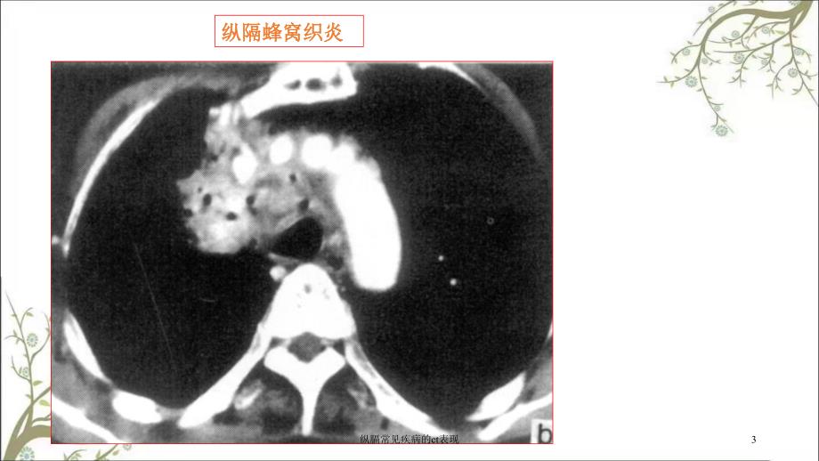 纵膈常见疾病的ct表现课件_第3页