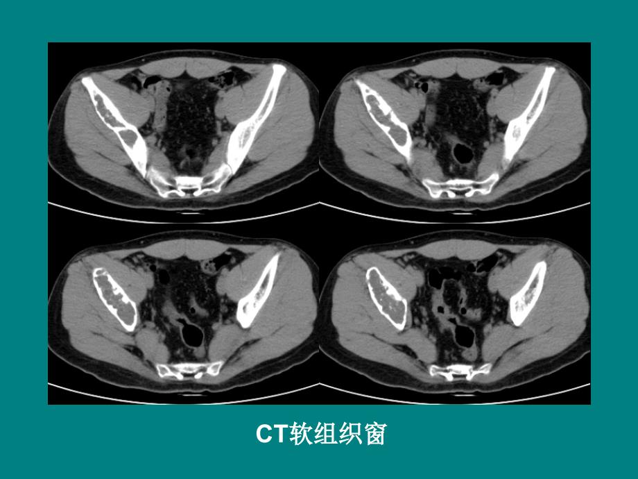 髂骨软骨粘液样纤维瘤读片_第3页