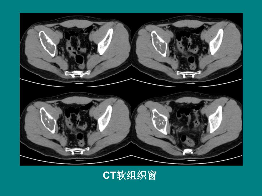 髂骨软骨粘液样纤维瘤读片_第4页