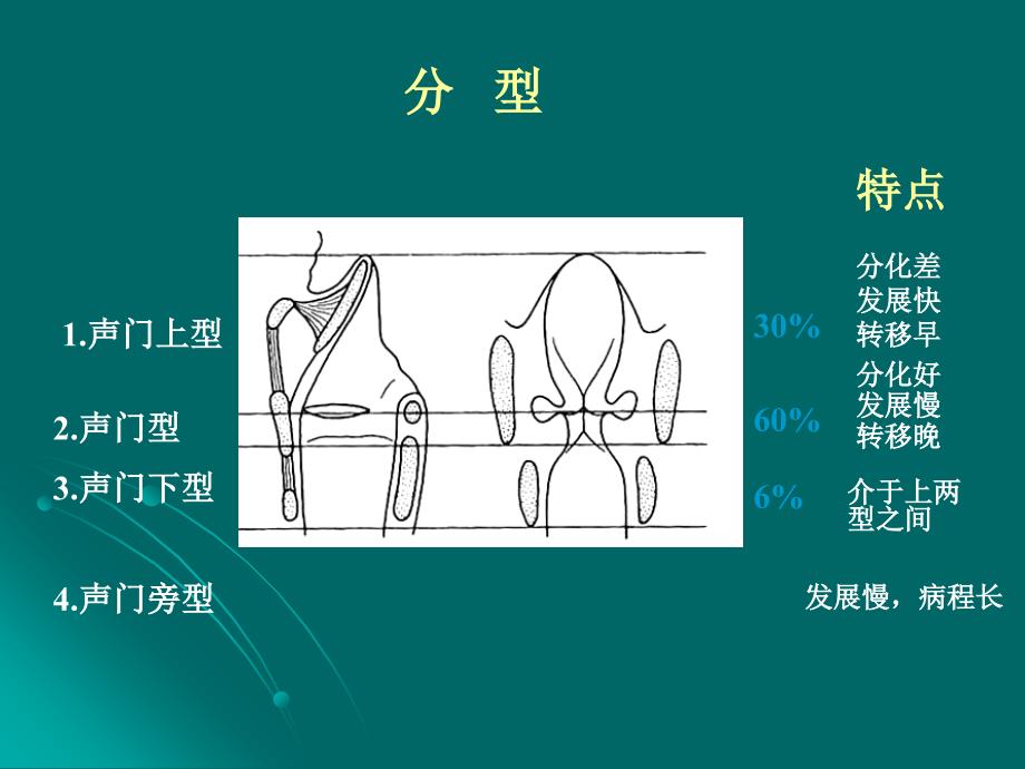 喉癌的护理.ppt_第4页